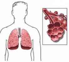 Abces pulmonar