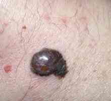 Testul de sânge în melanomul: identificarea bolii