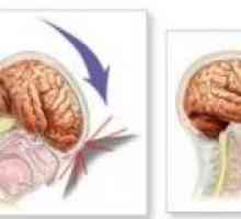 Traumatisme cranio-cerebrale - consecințele, reabilitare