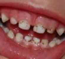 Ce se poate face în cazul în care placa ta copilul pe dinti?