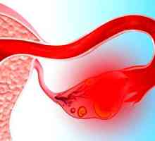 Ce este apoplexia ovariene, simptome și tratament