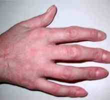 Deformarea degetului