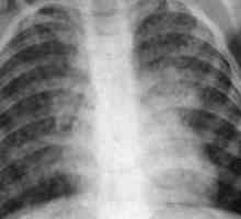 Tuberculoza diseminata: cauze, simptome, tratament