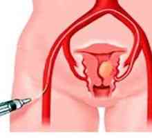Fibrom uterin - Simptome, Diagnostic, Tratament