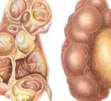 Hidronefroza rinichi - cauze, simptome, diagnostic și tratament
