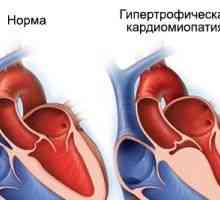 Cardiomiopatia hipertrofica, cauze, simptome, tratament