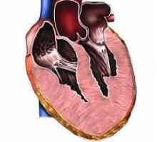 Hipertrofiei ventriculului drept