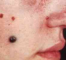 Israelul oferă metode inovatoare în lupta împotriva melanomului.