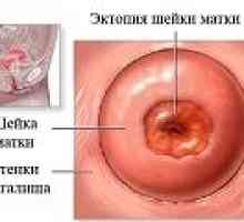 Ectopie de col uterin, ce este?
