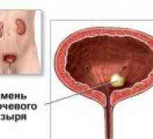 Pietre vezicii urinare: simptome, tratament