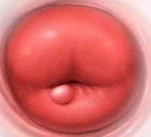 Chist de col uterin
