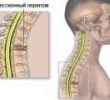 O fractură de compresie a coloanei vertebrale, simptome, tratament