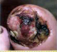 Melanomul unghiilor: semne, risc, diagnostic și tratament