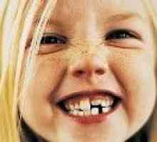 Malocluzie de dinți