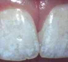 Cauzele pete albe pe dinti