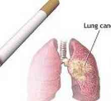Cauzele cancerului pulmonar la fumatori