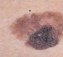 Caracteristicile și particularitățile tratamentul fazei melanom 3