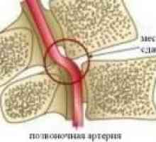 Sindromul arterei vertebrale în osteocondrozei cervicale