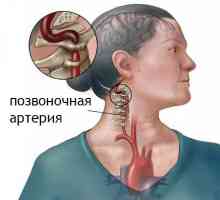 Sindromul arterei vertebrale în osteocondrozei cervicale: simptome, prevenirea