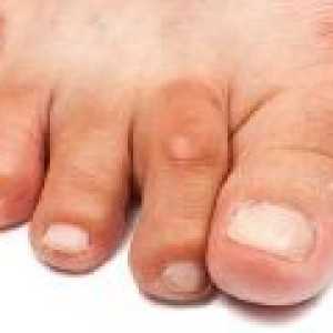 Artrita degetelor de la picioare și a picioarelor, simptome și tratament