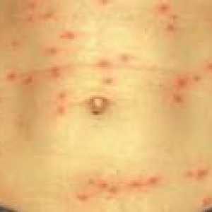 Febră tifoidă - tratament, metode de infectare