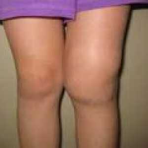 Deformând artroza articulației genunchiului