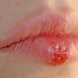 Infecție herpetică: cauze, simptome, tratament