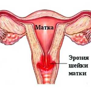 Cum de a trata eroziunea de col uterin