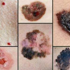 Ce caracteristici caracterizează dezvoltarea melanomului și cum se instalează prognoza