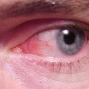 Conjunctivită sau roșu ochi: simptome, tratament