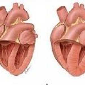Boli de inima pulmonare: cauze, simptome, tratament