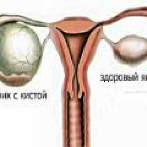 Chist Parovarian de ovar - cauze, simptome, tratament