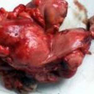 Cancerul de col uterin - previziuni tratamente