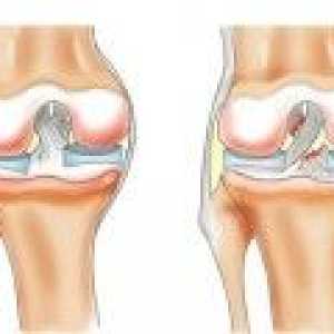 Simptomele și tratamentul ruptura a meniscului articulației genunchiului