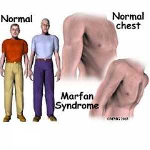 Sindromul Marfan