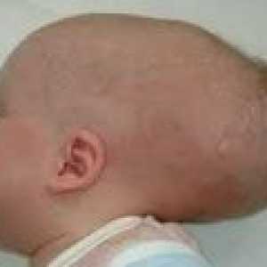 Hidrocefalie congenitală în copil: cauze, simptome, tratament