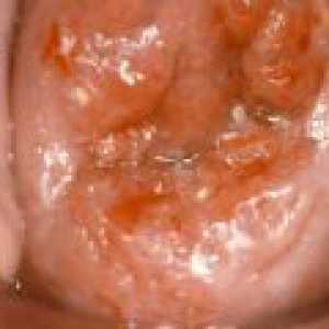Alocarea după intoxicarea eroziune de col uterin