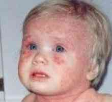 Dermatita atopica la copii, simptome și tratament