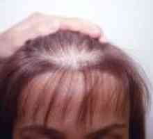Alopeciei androgene la femei, simptome, tratament