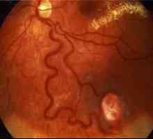 Ochii Angiomatoza retiniana