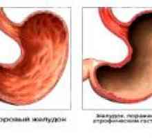 Antrale gastrita atrofică: Cauze, simptome, tratament