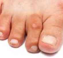 Artrita degetelor de la picioare și a picioarelor, simptome și tratament