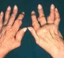 Artrita articulațiilor degetelor: simptome si tratament