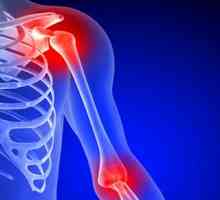 Osteoartrita articulatiei umarului: Simptome si tratament