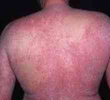 Dermatita atopică la adulți