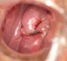 Sarcina cu un cervix scurt