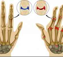 Tratarea biologică a artritei reumatoide: tratament și medicamente
