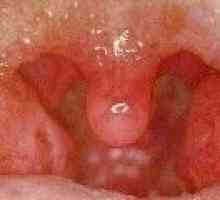 Durere în gât la înghițire, din cauza faringita