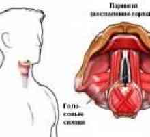 Durere în gât la înghițire, din cauza laringitei
