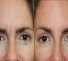 Botox tratament anti-rid - indicații de utilizare